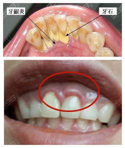 牙龈炎是什么样？看牙龈炎图片及治疗方法了解它